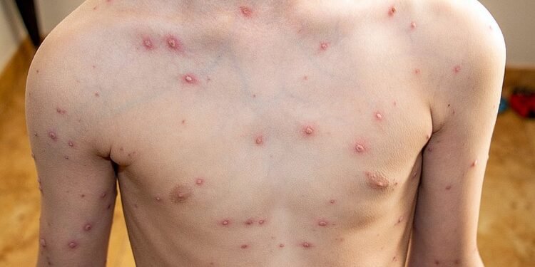 Salvador confirma dois novos casos de varíola dos macacos