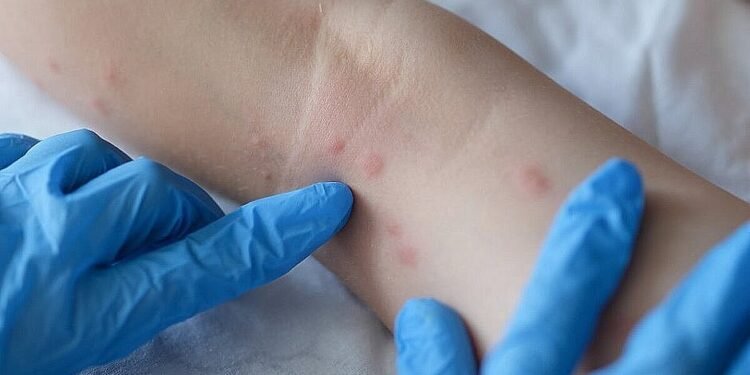 MP-BA pede esclarecimentos sobre prevenção da varíola dos macacos nos presídios e escolas