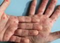 Bahia tem 55 casos de Monkeypox