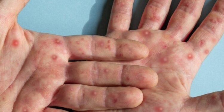 Bahia tem 55 casos de Monkeypox