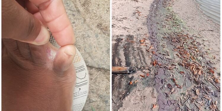 Pessoas sofrem coceira e mal-estar após contato com substância desconhecida em Barra do Jacuípe