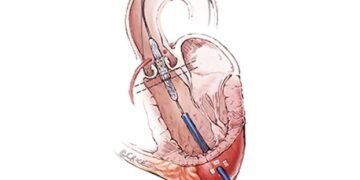 Implante de válvula cardíaca é opção para pacientes muito idosos e/ou que não podem se submeter a uma cirurgia
