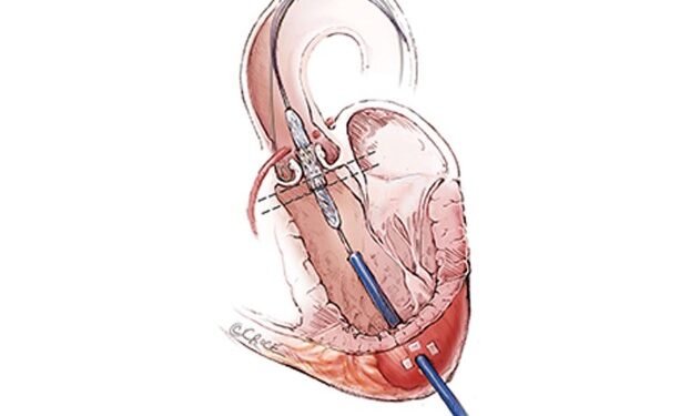 Implante de válvula cardíaca é opção para pacientes muito idosos e/ou que não podem se submeter a uma cirurgia