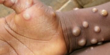 Bahia recebe 412 mil doses de vacinas contra varíola dos macacos