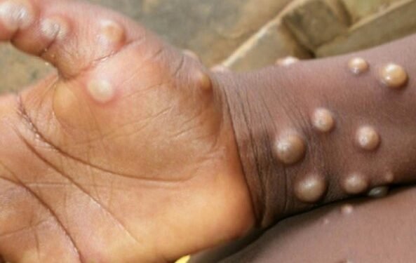 Bahia recebe 412 mil doses de vacinas contra varíola dos macacos